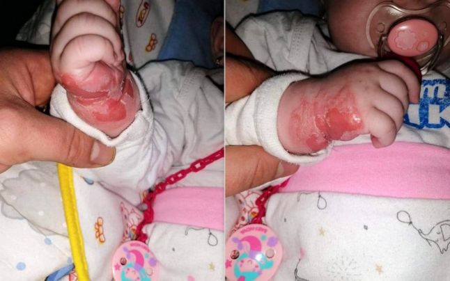 Răni grave pe mânuţa unei fetiţe de 5 luni, din cauza leucoplastului. „O săptămână nu i-au schimbat bandajele”